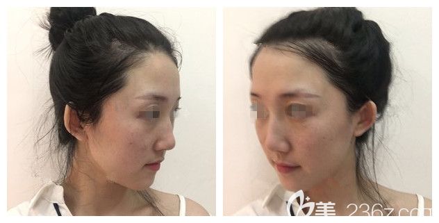 闺蜜两颊的晒斑较多 闺蜜两颊的晒斑较多