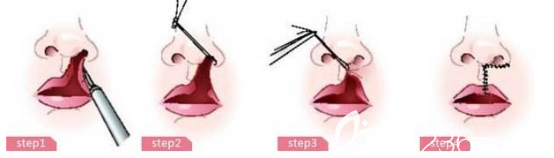 唇腭裂手术过程