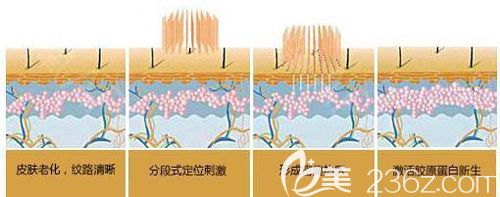 激光去痤疮治疗步骤示意图