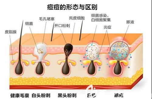 痘痘形成的具体原因以及类型