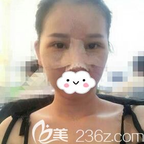 做眼综合+鼻综合术后第3天