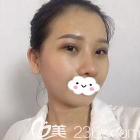 在华美做眼综合+鼻综合术后第8天恢复效果