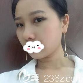 在海南华美做眼鼻综合术后25天恢复照