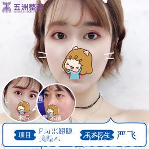 严飞院长做双眼皮术前术后变化明显 严飞院长做双眼皮术前术后变化明显