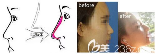 硅胶假体隆鼻手术效果好还安全 硅胶假体隆鼻手术效果好还安全