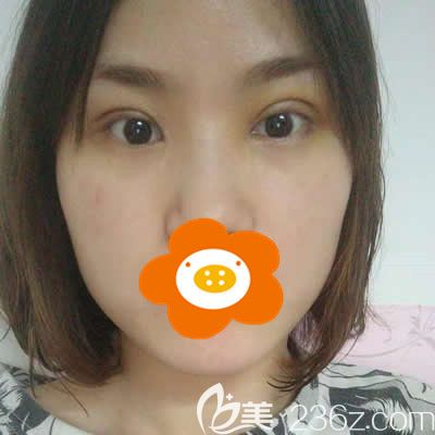 我找<!--<i data=20240703-sp></i>-->张慧慧医生做双眼皮术后半月后照片