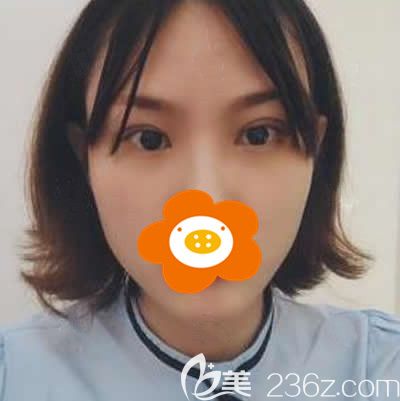 我找<!--<i data=20240703-sp></i>-->张慧慧医生做双眼皮术后30天效果展示