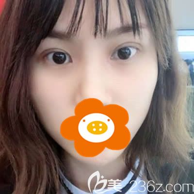在做了切开双眼皮+开眼角半年后眼部线条简直美呆了