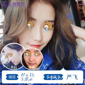 严飞做鼻部整形术后鼻子明显变挺 严飞做鼻部整形术后鼻子明显变挺