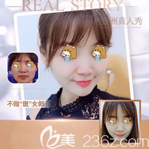 五洲莱美做超皮秒祛斑术后皮肤白净 五洲莱美做超皮秒祛斑术后皮肤白净