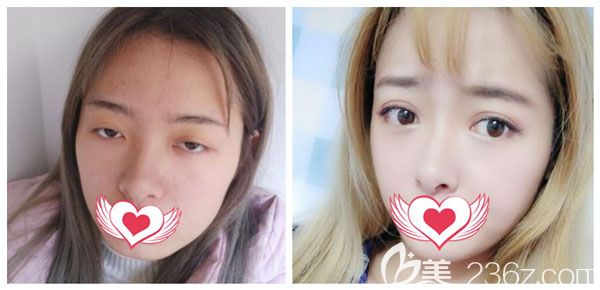 汪妍做全切双眼皮+开眼角案例效果对比图