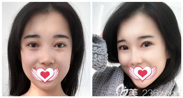 戴巍做肋软骨隆鼻+耳软骨垫鼻尖案例