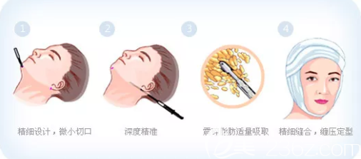 面部吸脂手术过程