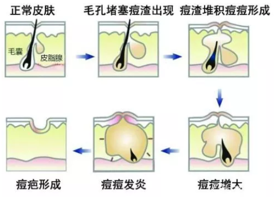 痘痘的形成