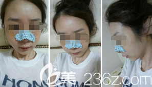 张伟医生为我刚做完立秀膨体隆鼻术后鼻子微肿