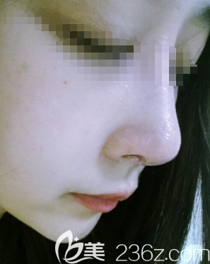 在邯郸京美做膨体隆鼻术后一周鼻子拆线