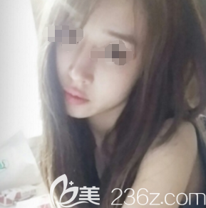 张伟医生为我做膨体隆鼻术后20天鼻子消肿