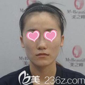 在美之峰做面部脂肪填充术前照 在美之峰做面部脂肪填充术前照