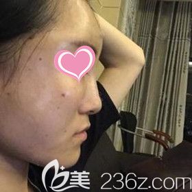 做自体脂肪填充面部术后3天 做自体脂肪填充面部术后3天