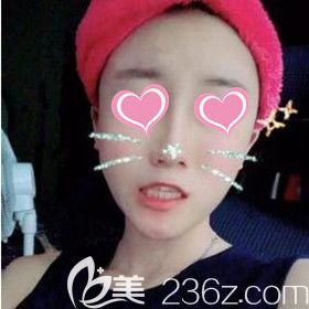 在美之峰做面部脂肪填充术后18天效果图 在美之峰做面部脂肪填充术后18天效果图