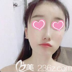 在长沙美之峰做自体脂肪填充面部术后30天效果照 在长沙美之峰做自体脂肪填充面部术后30天效果照