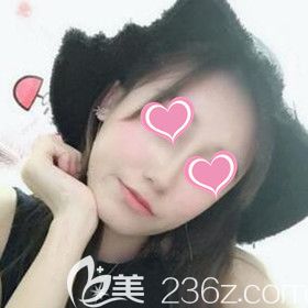 面部凹陷的我找长沙美之峰丁翔做了自体脂肪填充面部后终于重现少女颜！