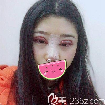 在南阳维多利亚做双眼皮和隆鼻3天后的改变