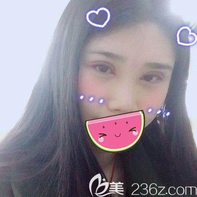 做全切双眼皮和硅胶假体隆鼻后7天的样子