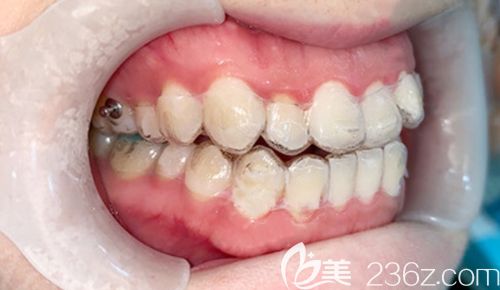 戴隐形牙套矫正两个月时的效果