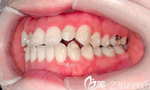 矫正牙性地包天6个月的效果图