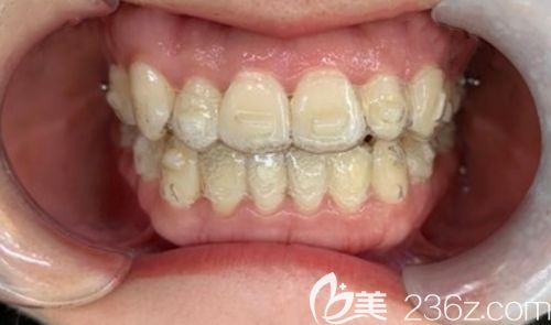 牙性地包天的朋友看过来，这有我在深圳韦博口腔戴隐形牙套矫正反颌一年的效果图
