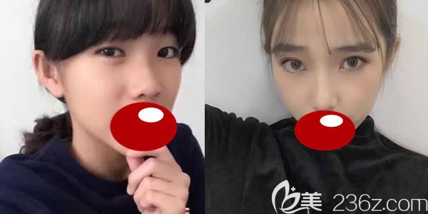 福州名韩察鹏飞医生切开双眼皮+显微开眼角真人案例