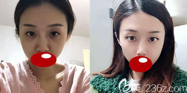 福州名韩温名赟医生自体脂肪全面部填充前后对比效果