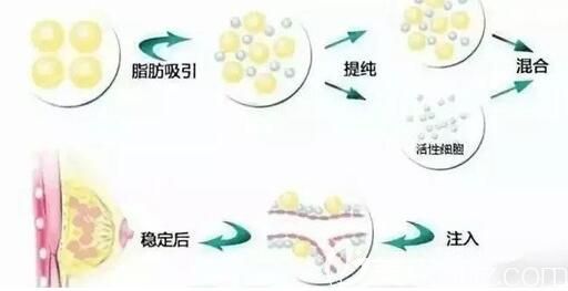 自体脂肪丰胸首先要对脂肪细胞进行纯化分离
