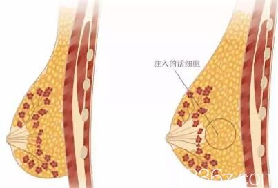 自体脂肪丰胸的方法是注入活性细胞