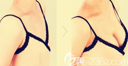 自体脂肪丰胸案例对比图