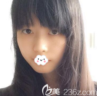 在广州广大整形做隆鼻术前照片 在广州广大整形做隆鼻术前照片