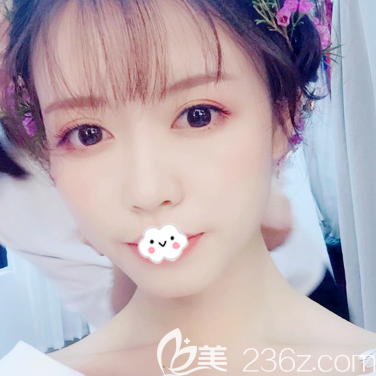 广州广大整形医院王政医生做的隆鼻<span style= 广州广大整形医院王政医生做的隆鼻<span style=