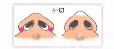 缩小鼻翼外切口图示