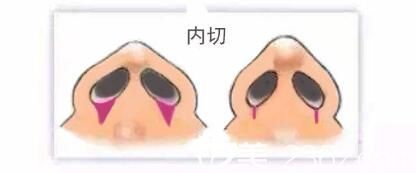 鼻翼内切切口演示图