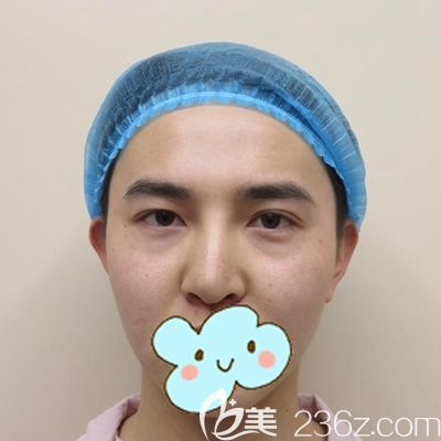 洛阳爱尚鼻综合手术前 洛阳爱尚鼻综合手术前