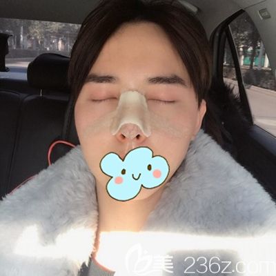 洛阳爱尚耳软骨隆鼻术后3天 洛阳爱尚耳软骨隆鼻术后3天