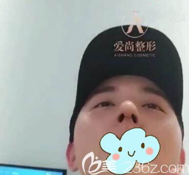 洛阳爱尚耳软骨鼻综合隆鼻术后10天 洛阳爱尚耳软骨鼻综合隆鼻术后10天