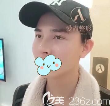 洛阳爱尚隆鼻后35天 洛阳爱尚隆鼻后35天
