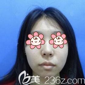 做假体垫下巴术前照 做假体垫下巴术前照