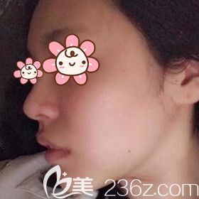 在沈阳名流做假体垫下巴术后5天效果图 在沈阳名流做假体垫下巴术后5天效果图