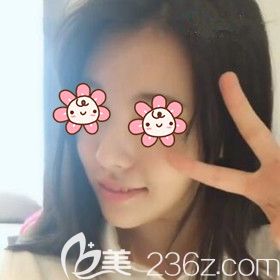 在沈阳做假体垫下巴术后半个月效果 在沈阳做假体垫下巴术后半个月效果