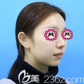 去雅美打玻尿酸垫下巴术前照 去雅美打玻尿酸垫下巴术前照