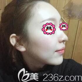 注射玻尿酸垫下巴术后4天照 注射玻尿酸垫下巴术后4天照