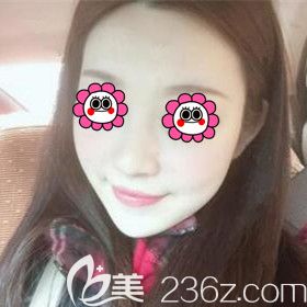 在雅美注射玻尿酸垫下巴术后11天效果照 在雅美注射玻尿酸垫下巴术后11天效果照